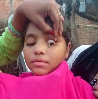 Doctors In Shock As Young Girl Cries Stone Tears From One Eye (Photos)